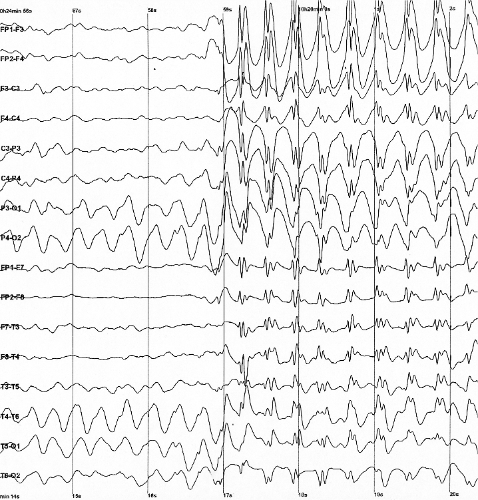 Generalized 3 Hz spike and wave discharges in EEG during a seizure