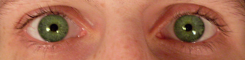 Constricted pupils